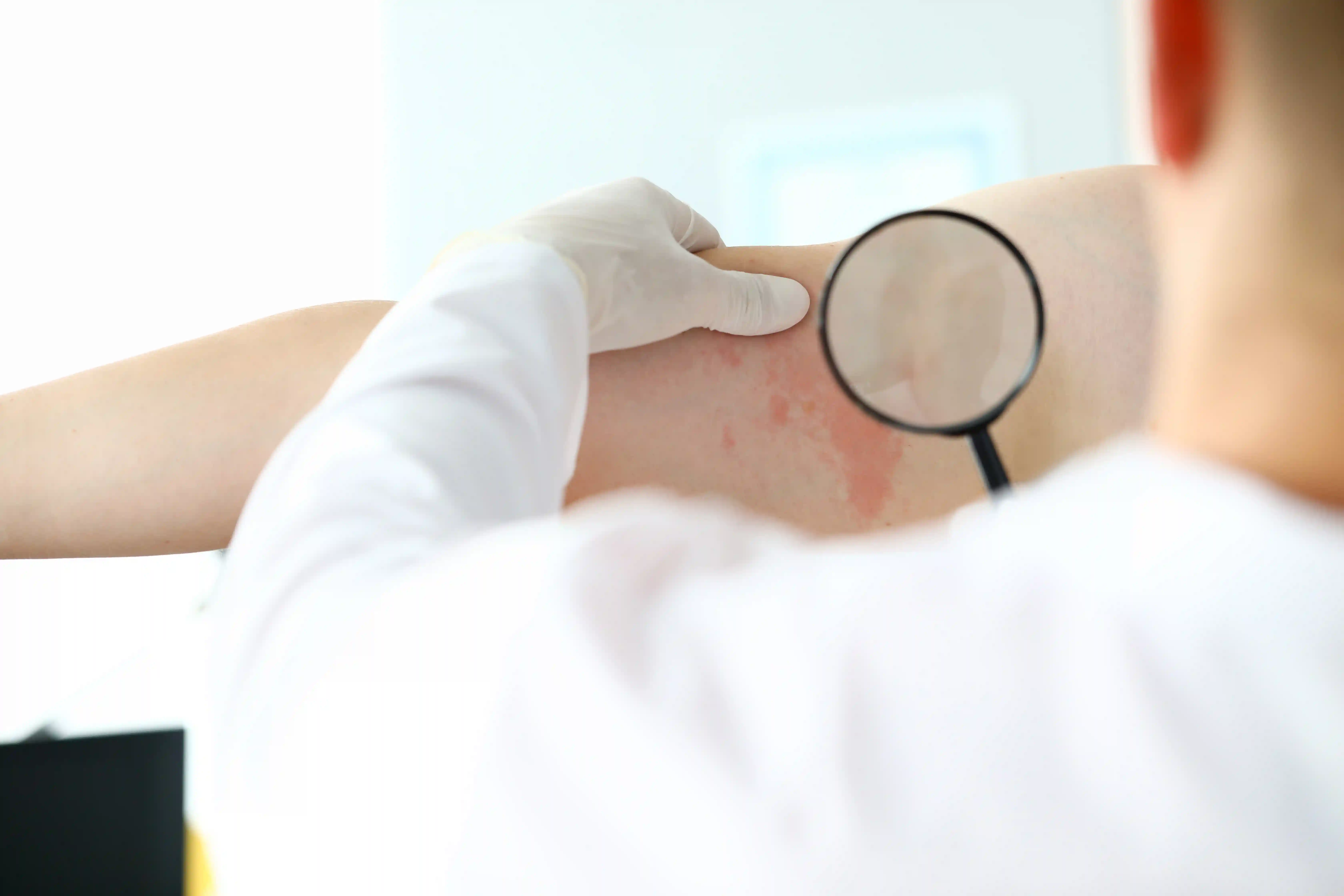 Role of Urea Creams in Supportive Oncology Skin Care